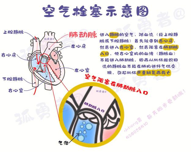 CT技术在诊断空气栓塞中的应用与价值_ct能照出空气栓塞 割草机维修
